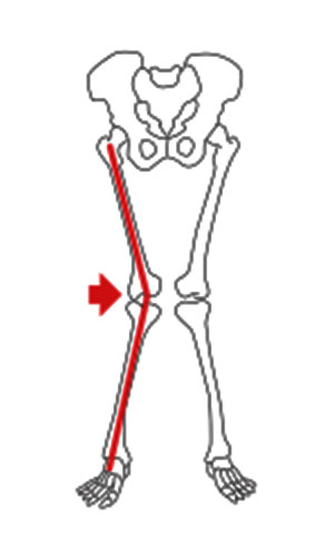 2. Joelho para dentro (valgo) 