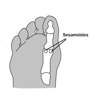 dor todos metatarsos sesamoide sesamoidite