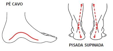bunionette pe cavo tipo pisada supinada