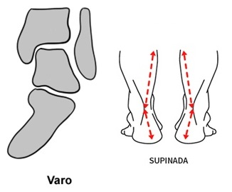Tornozelo com alinhamento em varo e pisada supinada