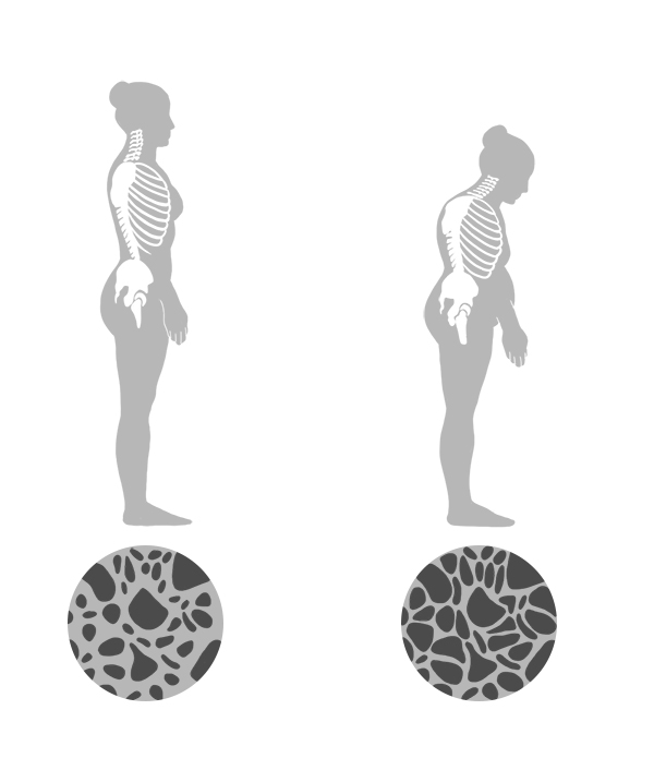 Comparação entre osso normal e osso com osteoporose.