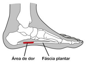 Fascite plantar