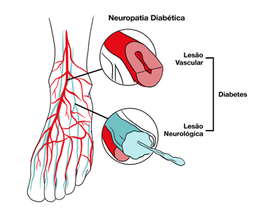 Neuropatia Periférica Diabética.