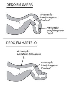 Comparação entre o dedo em martelo com o dedo em garra.