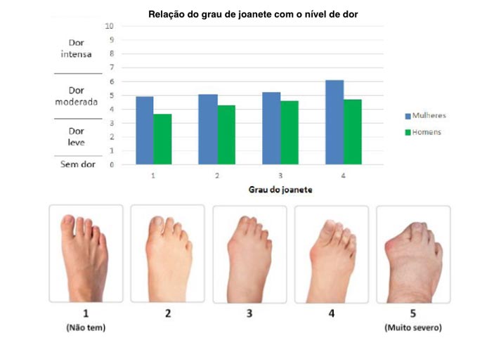 São duas imagens, uma é um gráfico mostrando que as mulheres sofre mais com a patologia e a outra são os diferentes graus do joanete.