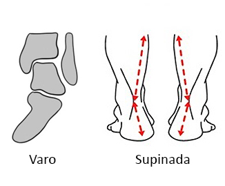 Tornozelo varo e pisada supinada